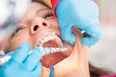 Patientin erhält professionelle Zahnreinigung beim Zahnarzt