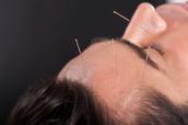 Mann bei einer Akupunktur-Behandlung am Kopf