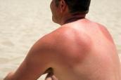 Mann am Strand mit Sonnenbrand