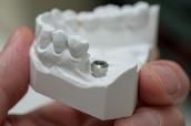 Modell eines Zahnimplantats