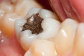 Zahn mit Amalgam-Füllung
