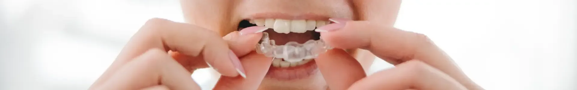 Eine Frau setzt mit beiden Händen eine transparente Zahnschiene in ihren Oberkiefer ein.