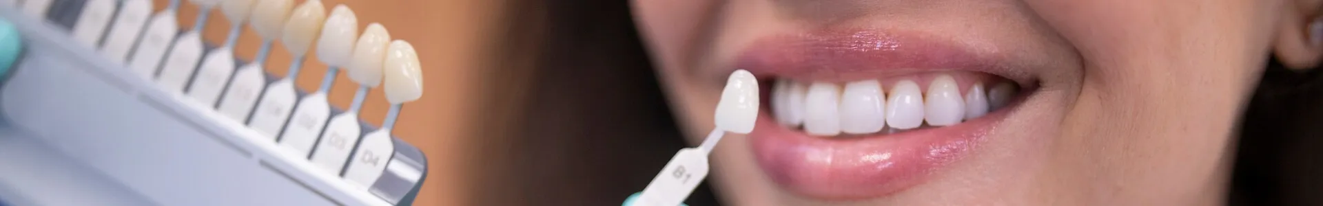 Eine Frau lächelt, während ein Zahnarzt eine Zahnfarbskala an ihre Zähne hält, um den passenden Farbton für eine Zahnbehandlung zu bestimmen.