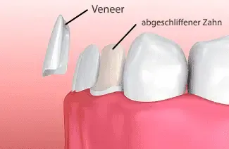 Ein Veneer verblendet den Zahn.