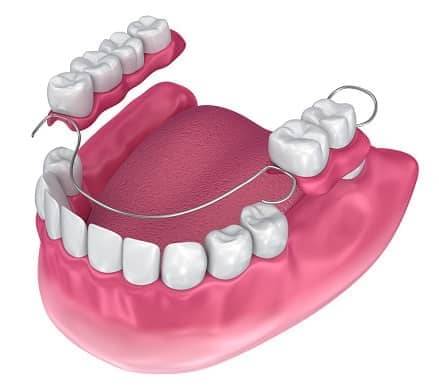 Zahnprothese oberkiefer ohne gaumenplatte