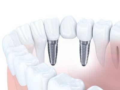 Zahnbrücke mit Halt durch beidseitige Implantate