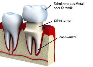 Illustration einer Zahnkrone